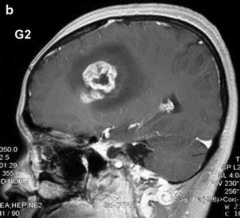 Glioblastoma Multiforme Concise Medical Knowledge