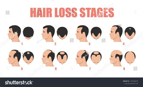 Hair Loss Stages Vector Isolated Male Stock Vector (Royalty Free ...