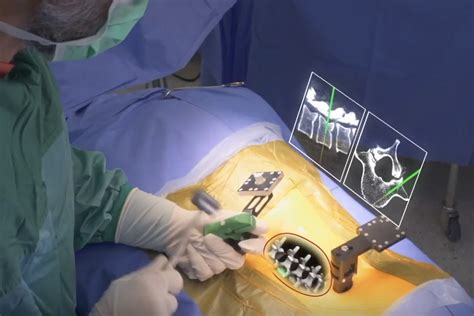 The 1st Augmented Reality Spine Surgeries Are Carried Out By Israeli Startup Augmedics Tiger