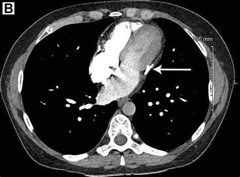 Constrictive Pericarditis