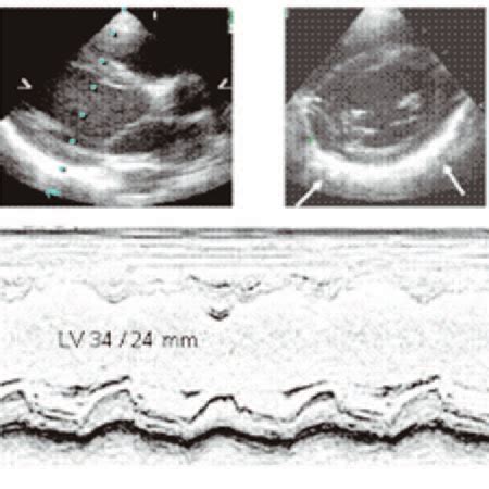 The Two Dimensional And M Mode Echocardiogram Shows Normal Left