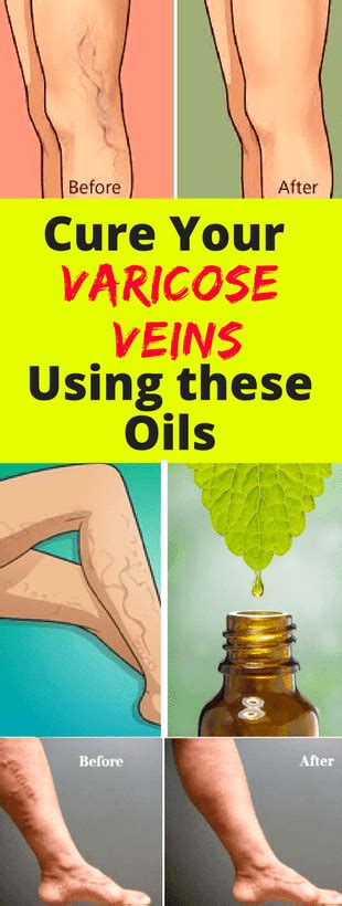 Cure Your Varicose Veins Using These Oils Health Tips And Trick