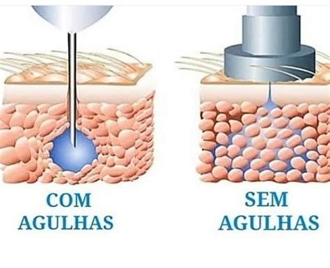 Lipo Enzim Tica Mesoterapia Sem Agulhas Cl Nica De Est Tica Em