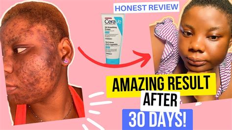 How I Cleared My Pcos Acne In 30 Days Cerave Sa Smoothing Cream Youtube