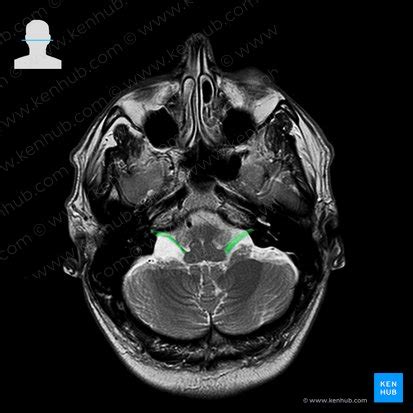 Vestibulocochlear nerve (CN VIII): Anatomy and pathway | Kenhub