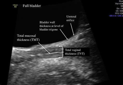 Dyspareunia Related To Gsm Association Of Total Vaginal Thickness Via