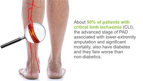 Leg Pain Can Be Signs Of Peripheral Artery Disease Especially In Men Thailand Medical News