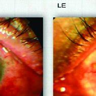 Anterior Segment Photograph Of The Right Eye RE And Left Eye LE