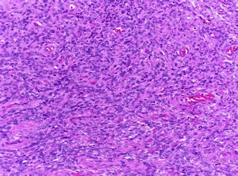 Solitary Fibrous Tumor This Low Power View Shows A Spindle Cell