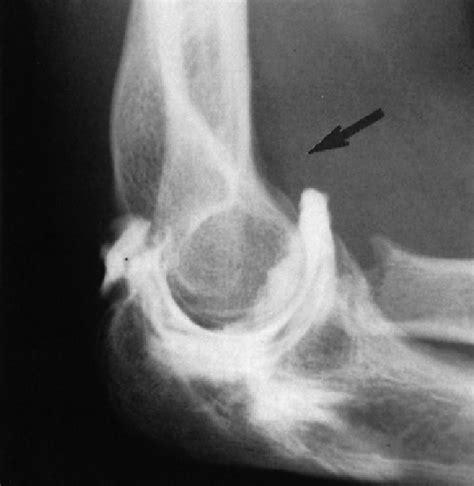 B Elbow With Adhesion Of The Anterior Capsule Arthrogram Revealed No