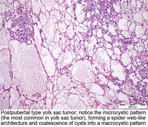 Pathology Outlines Yolk Sac Tumor