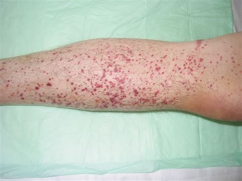 Vasculitis Skin Rash