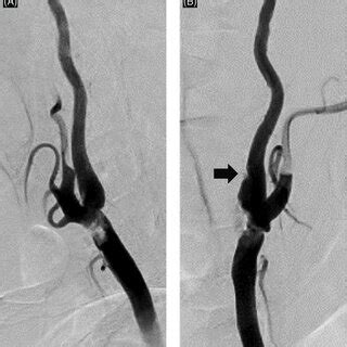 DSA Of The Left Common Carotid Artery A Lateral View A Slightly