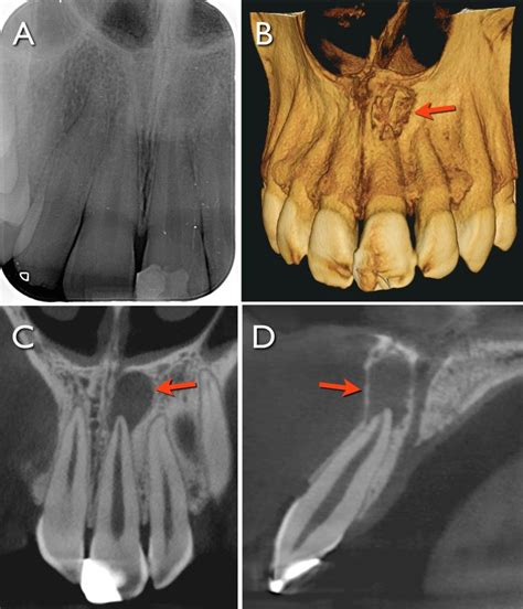 Uso de la Tomografía Volumétrica de Haz Cónico en Endodoncia