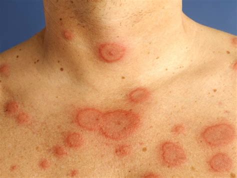 Erythema Marginatum Causes Treatment Pictures Symptoms