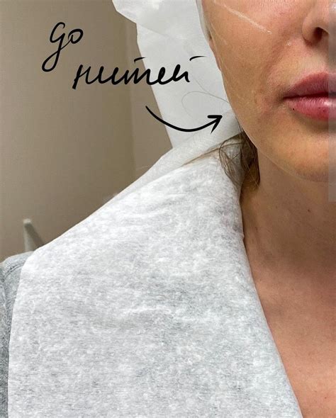 Подтяжка нитями Аптос в Минске, Установка в клинике МедЭстет