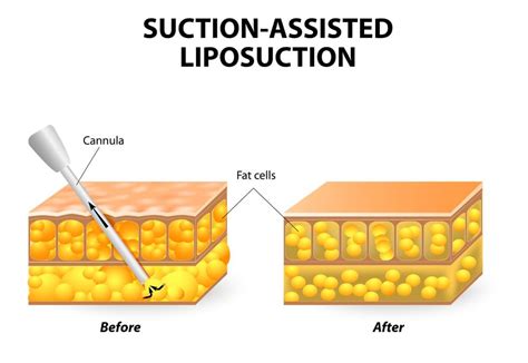 Liposuction » Bothell, WA Medspa - Dr. Robert Dragotti - Tao Cosmetics