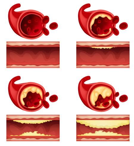 Diagram Showing Blood Clot Vector Art At Vecteezy