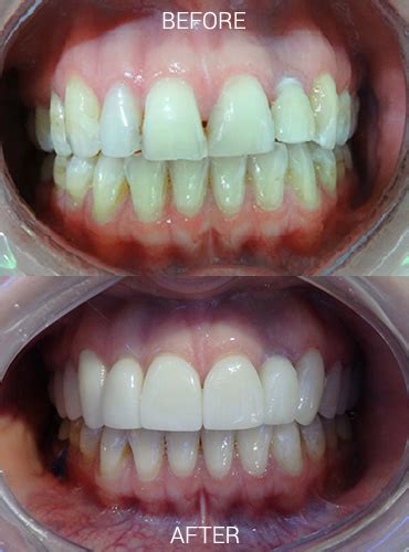 Lumineers Vs Veneers Before After