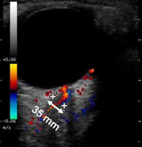 Transcranial Doppler And Optic Nerve Sonography Journal Of Cardiothoracic And Vascular Anesthesia