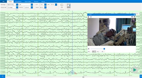 Enhancing Diagnostic Precision Exploring The Role Of Video Eeg