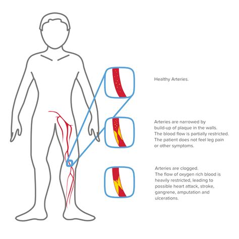 What Is Pad Mesi Simplifying Diagnostics