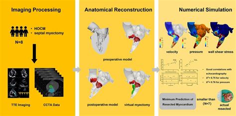 Patient Specific Computational Fluid Dynamics For Hypertrophic