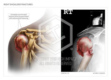 Right Shoulder Injuries High Impact® Visual Litigation Strategies™