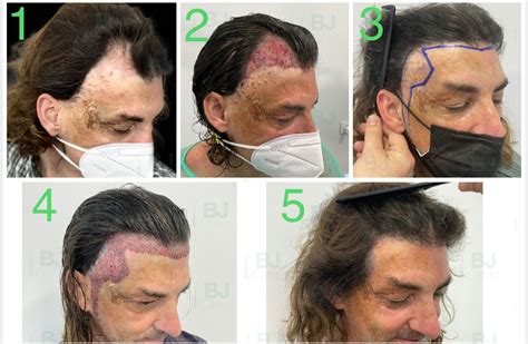 Reparaci N Bruno Jacobovski Bj Clinic Barcelona Recuperar El Pelo