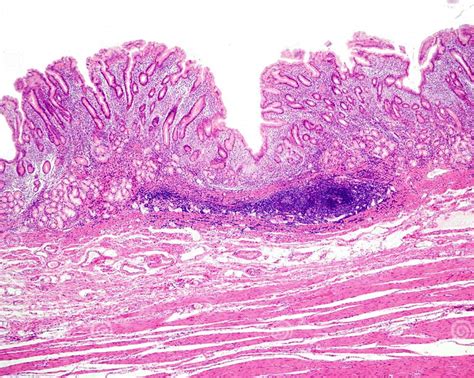 Human Stomach Chronic Gastritis Stock Image Image Of Histology Antrum 303145997