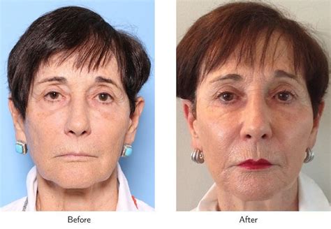 Non-Surgical Facelift Before & After Photos | Gold Coast Plastic Surgery