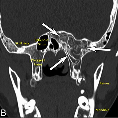 Arrested Pneumatization of the Sphenoid Sinus - Radiodontics