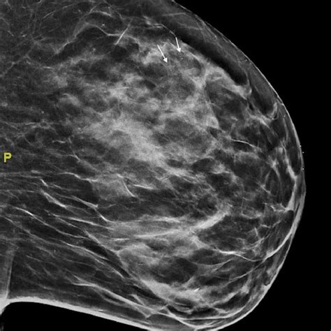 Diagnostic 3d Mammogram Left Craniocaudal View Showing 2 4 Cm