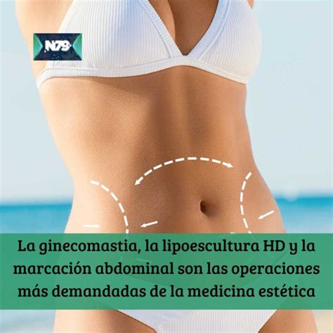 La Ginecomastia La Lipoescultura Hd Y La Marcaci N Abdominal Son Las