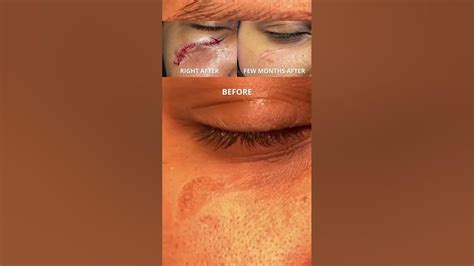 Scar Revision Before And After Dr Tanveer Janjua New Jersey Youtube