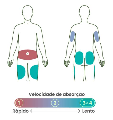 Diferen A Entre Locais De Aplica O De Insulina