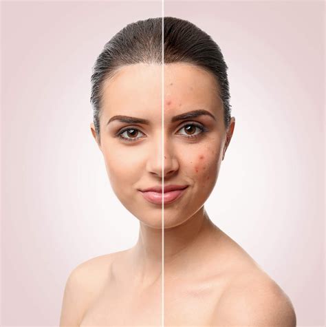 Halo Laser For Acne Scars Before And After – Cosmetic Surgery Tips