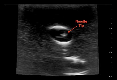 MedClub On Twitter RT Pocus101 New POCUS 101 Blog Post On