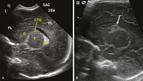 Fundamentals Of Pediatric Radiology Obgyn Key