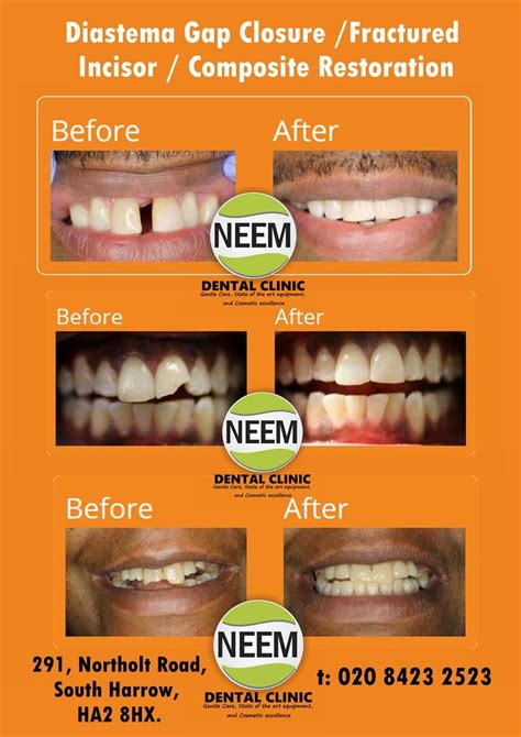 Diastema Gap Closure Fractured Incisor Composite Restoration