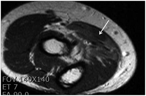 Axial T2 Weighted Magnetic Resonance Imaging Depicts Increased Signal