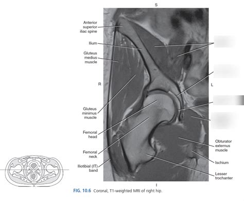 Coronal MRI Of Right Hip Diagram Quizlet