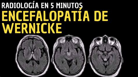 Radiología en 5 minutos Encefalopatía de Wernicke YouTube