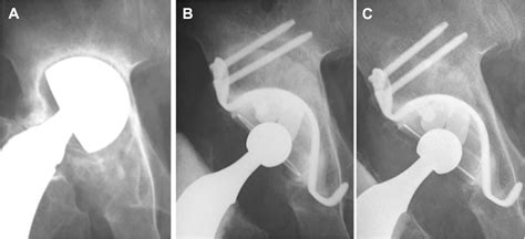 Bone Remodeling In Acetabular Reconstruction Using A Kerboull Type