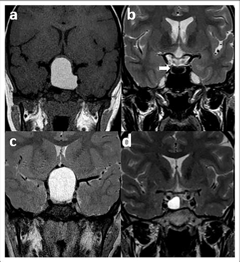 Figure 6 From Differentiation Of Pure Cystic Sellar Lesions On Magnetic