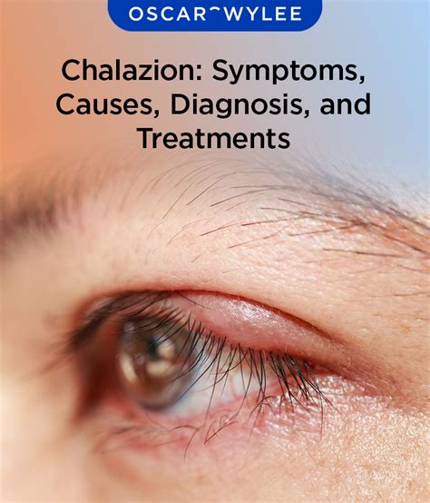 Chalazion Symptoms Causes Diagnosis And Treatments