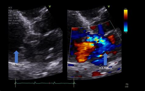 Grayscale And Doppler Echocardiogram Turbulent Flow From The Lcx Caf