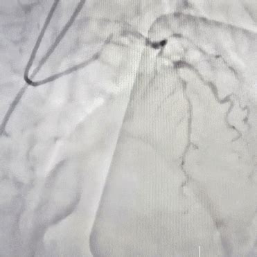 Pci Tavr