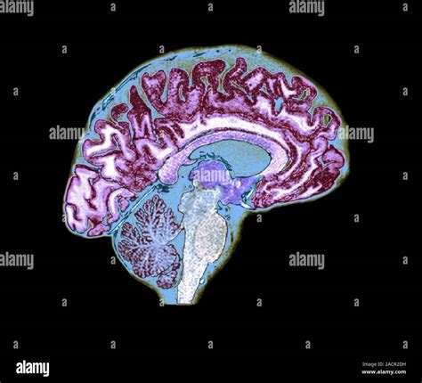 Brain Coloured Magnetic Resonance Imaging MRI Scan Of A Sagittal