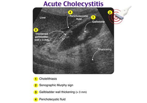 Which Is A Clinical Manifestation Of Cholelithiasis Quizlet Cheap Sale